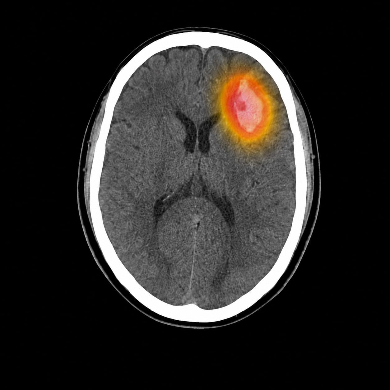 Head CT with an AI heatmap localizing an acute hemorrhage